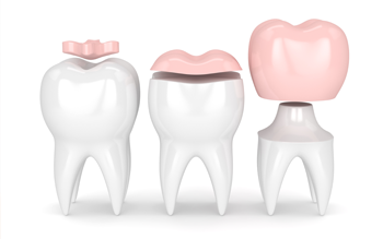 Dental Crowns