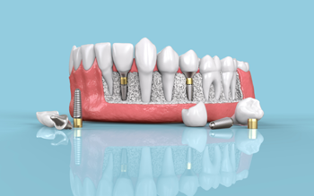Dental Implants